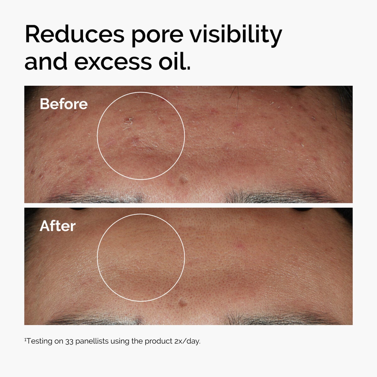 niacinamide-10-zinc-1-s6 ord-niacinamide-zinc-blemish-serum-before-after-pores.jpg