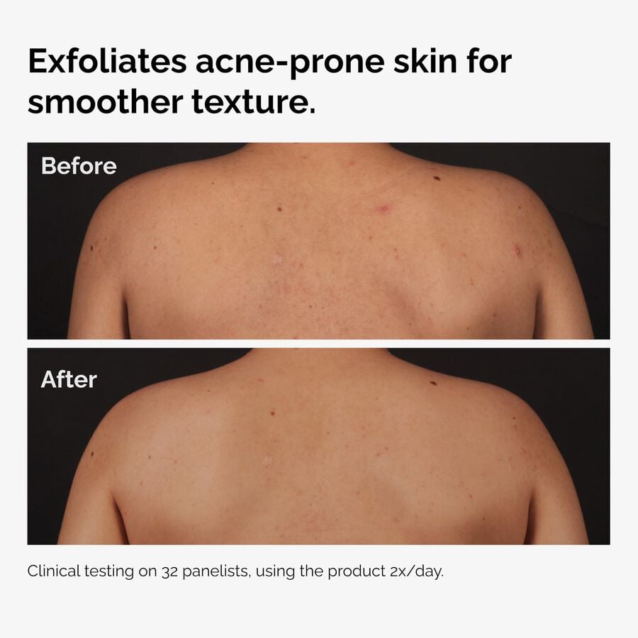 the-body-care-collection-i3 ord-salicylic-acid-body-serum-before-after-graphic-NA.jpg
