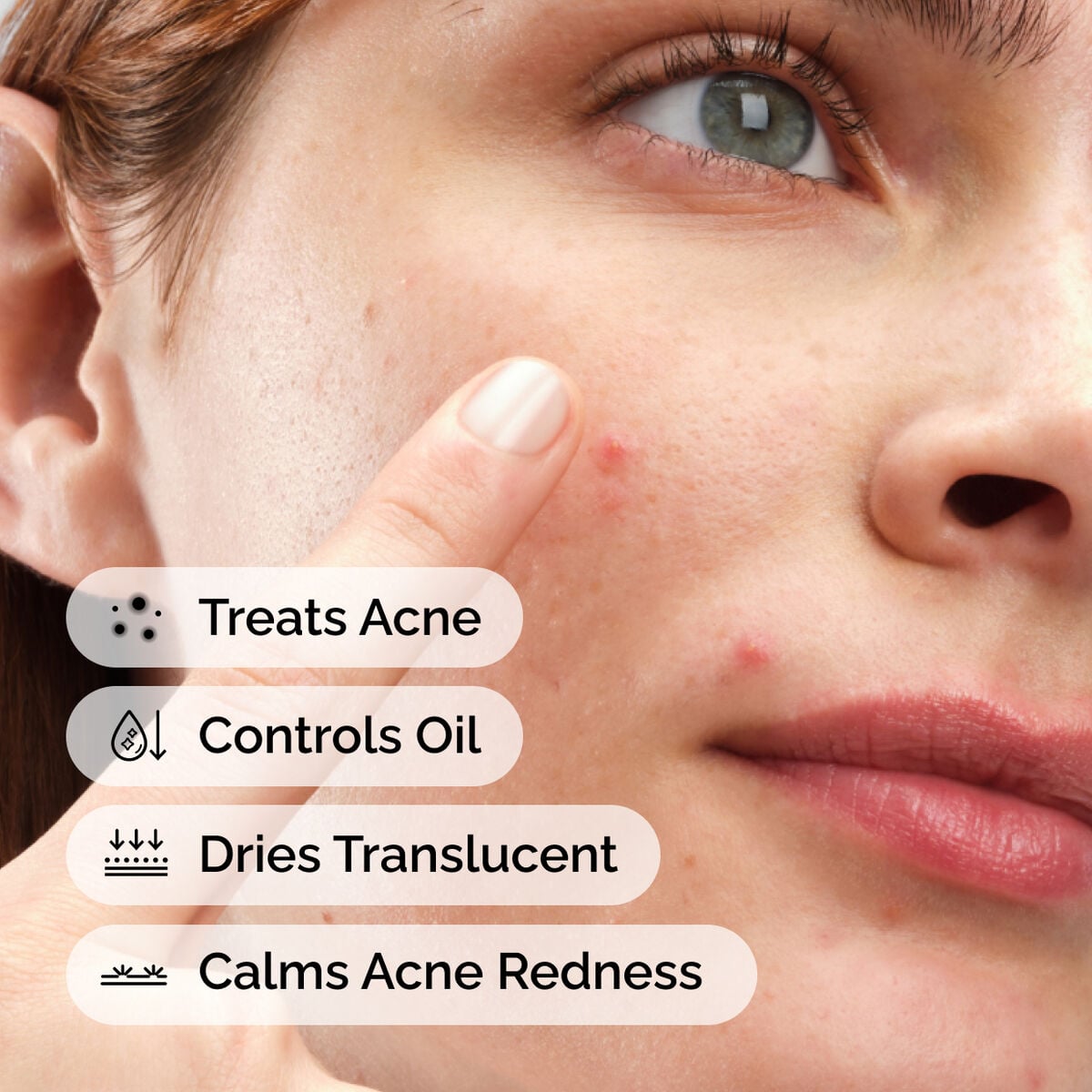 sulfur-10-powder-to-cream-concentrate-o8 ord-sulfur-10pct-powder-to-cream-concentrate-model-application-with-benefits-acne.jpg
