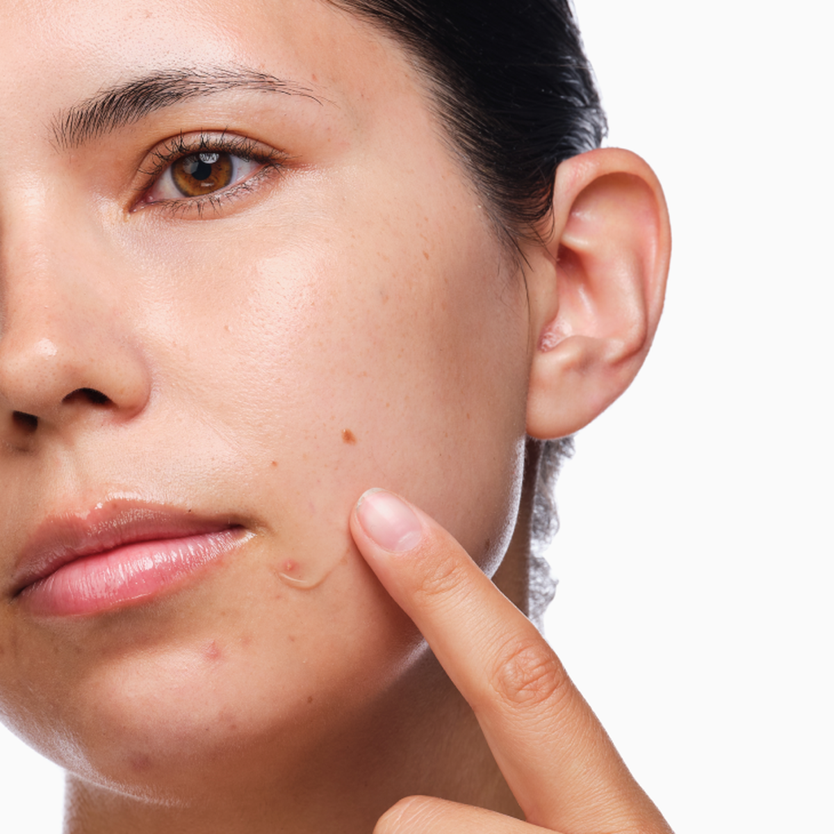 the-acne-set-z3 rdn-the-acne-set-application.png